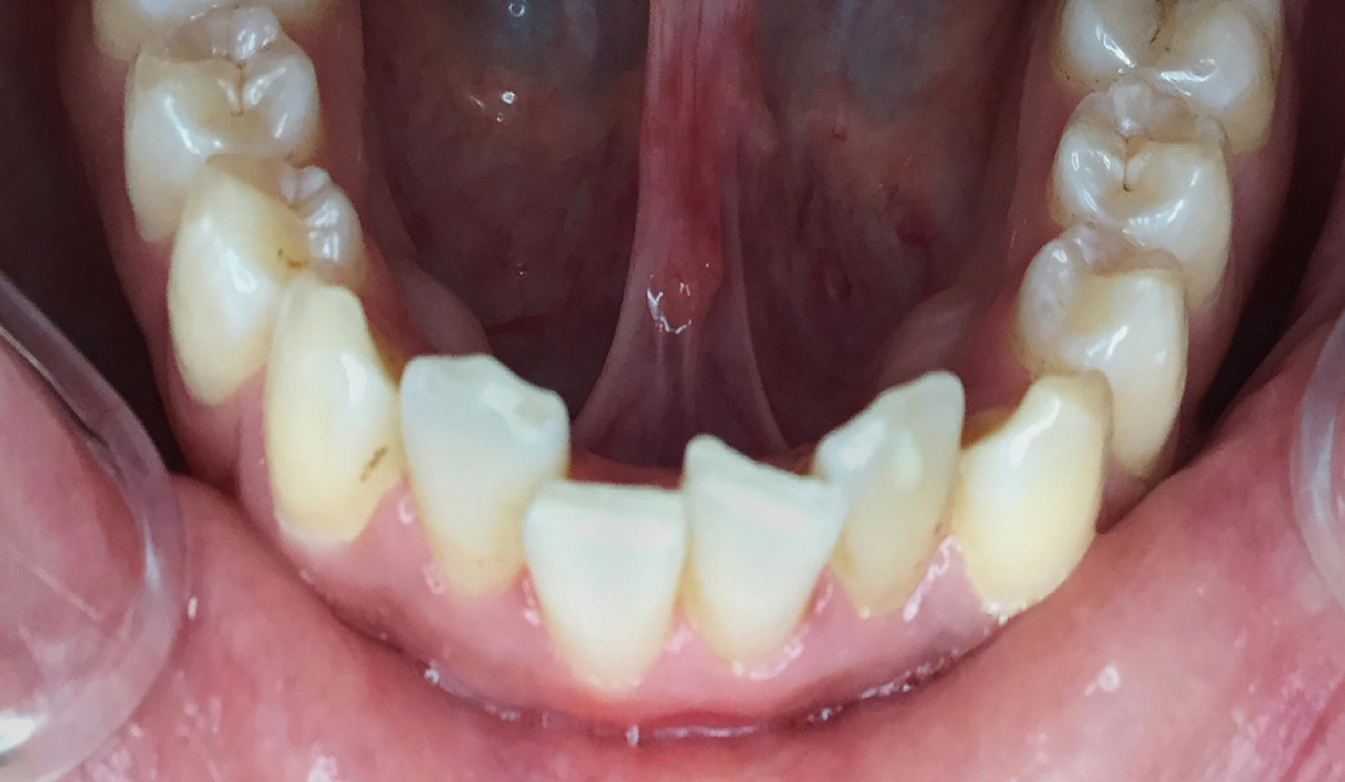 Case 3 CandidPro Before