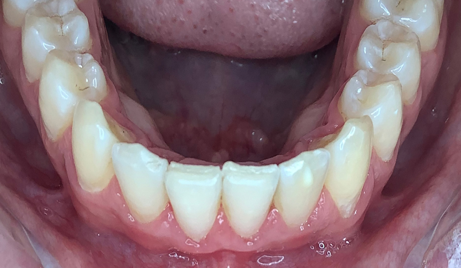 Case_3_After CandidPro