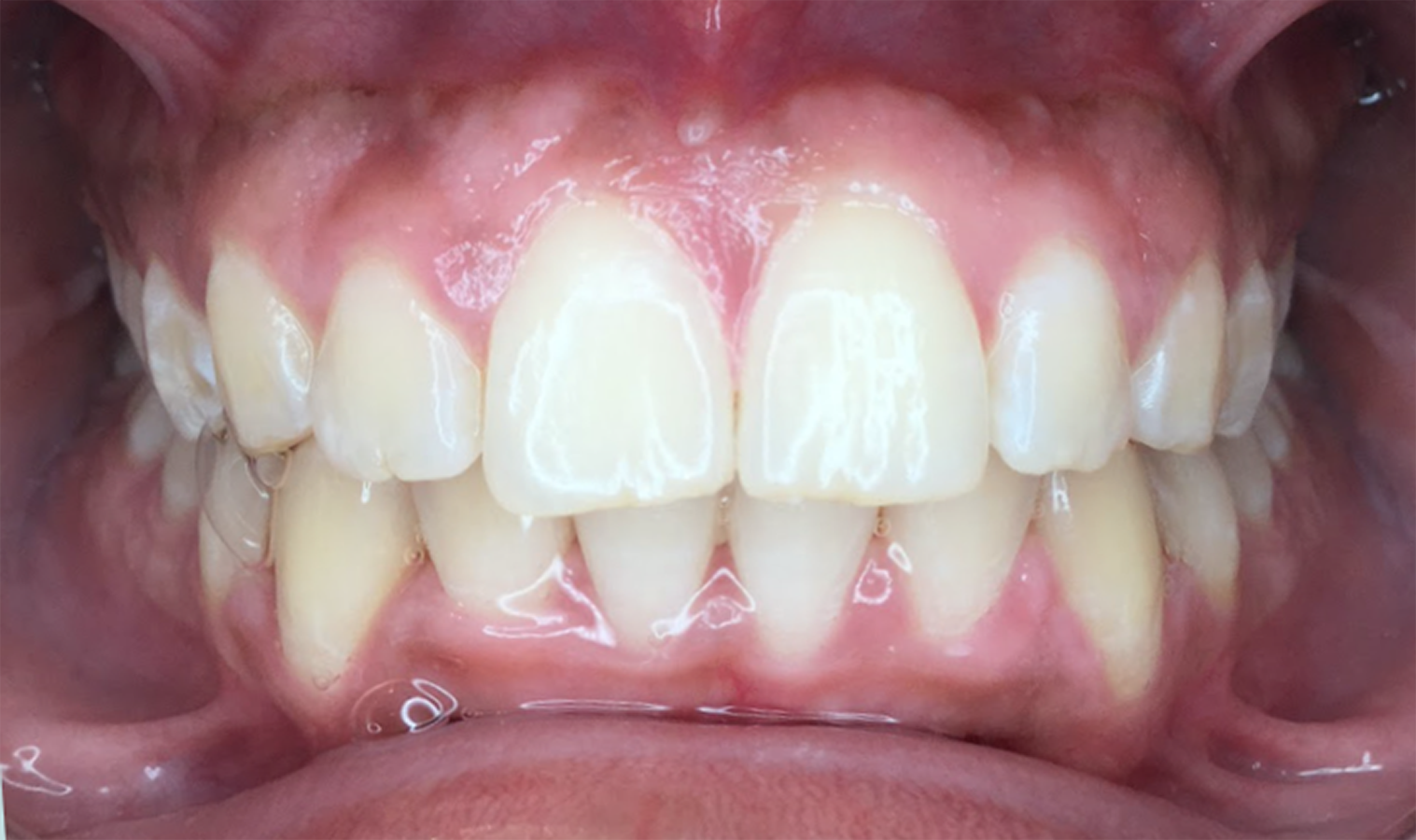 ProtrusionCase_After